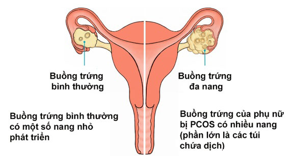 Buồng trứng đa nang là một bệnh thường gặp, chiếm tỷ lệ 6-10% phụ nữ trong độ tuổi sinh sản, nguyên nhân hàng đầu gây ra tình trạng hiếm muộn ở nữ giới